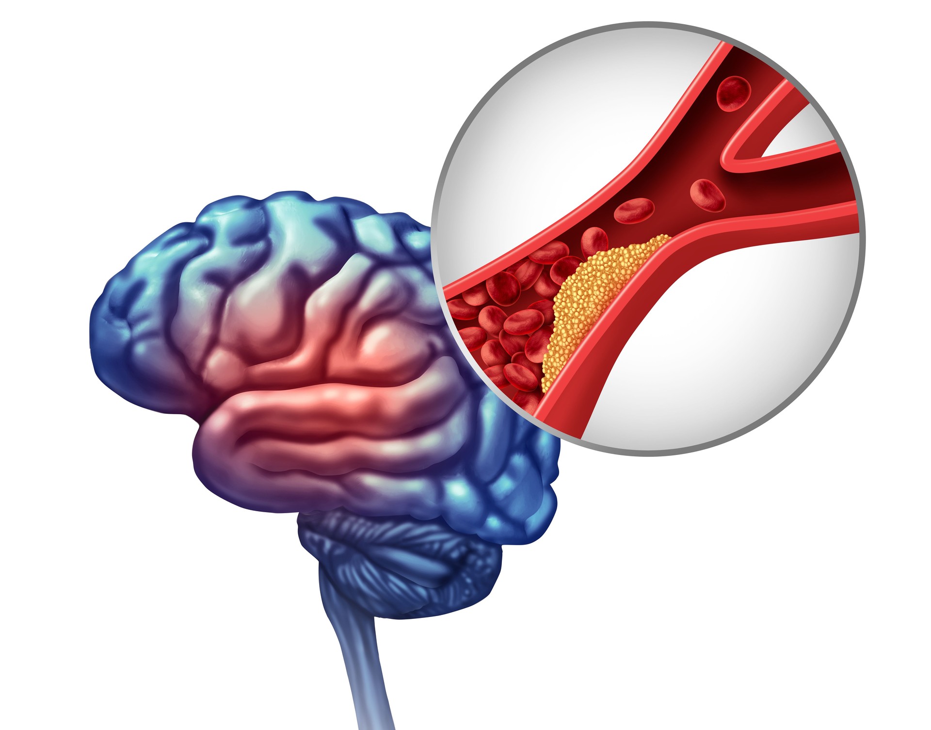 Mini Stroke